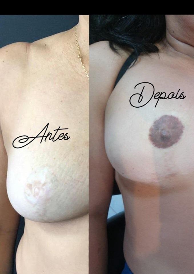 Antes e Depois Micropigmentação de Aréola