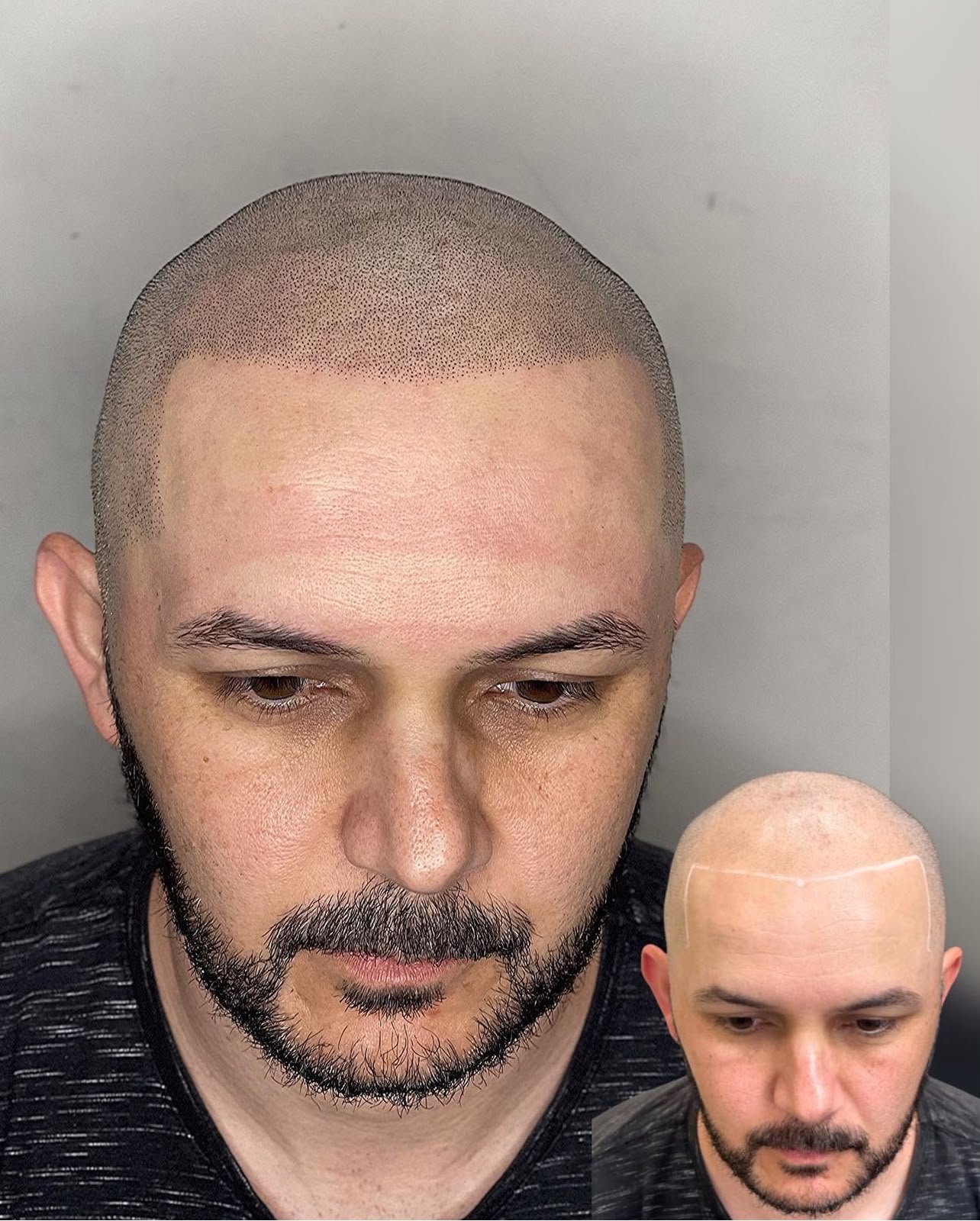 Resultado de micropigmentação capilar com linha frontal em alta definição - Rogério Plaça