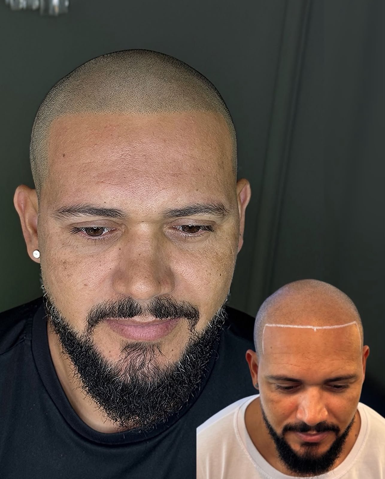 Contorno facial e simetria da linha frontal