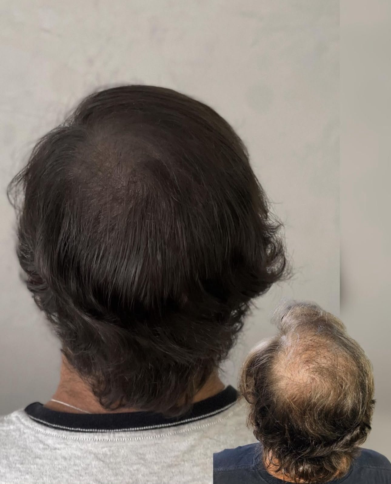 Reconstrução de densidade no topo e occipital